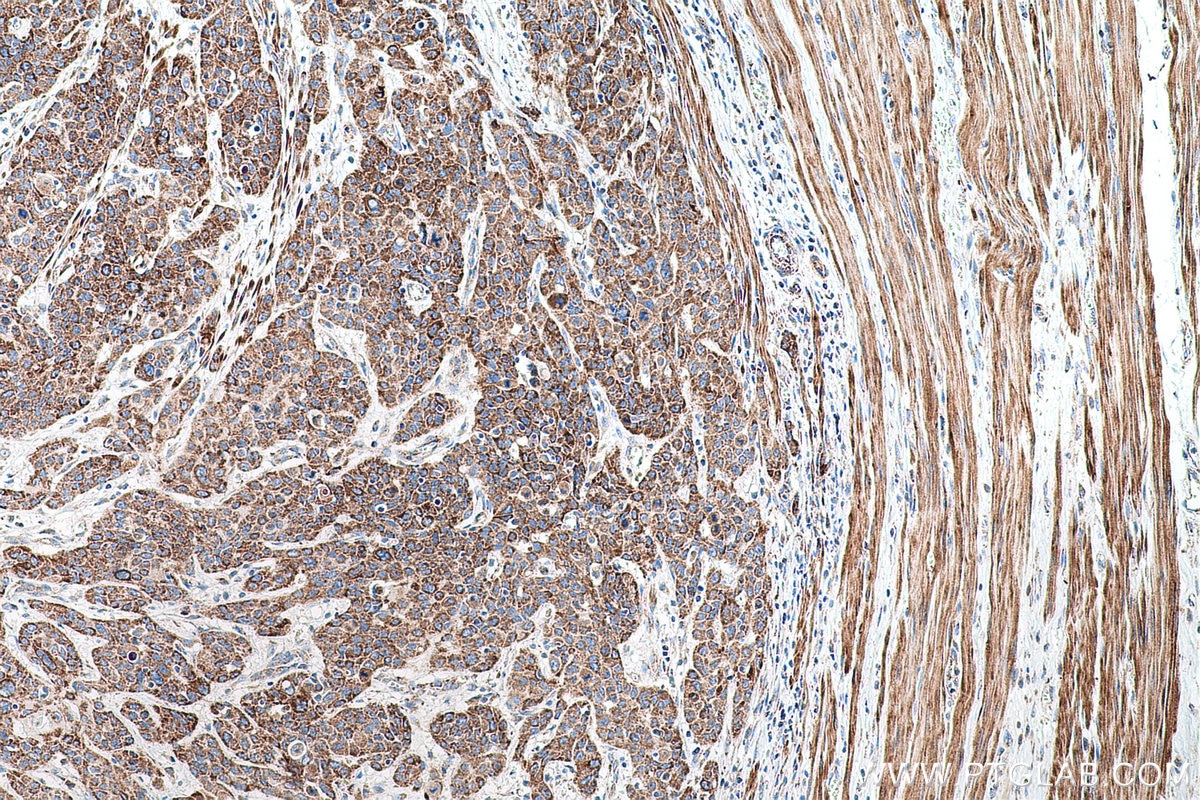 Immunohistochemical analysis of paraffin-embedded human oesophagus cancer tissue slide using KHC0692 (ANXA10 IHC Kit).