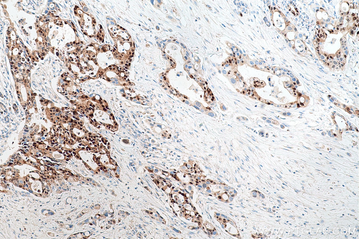 Immunohistochemical analysis of paraffin-embedded human pancreas cancer tissue slide using KHC0692 (ANXA10 IHC Kit).
