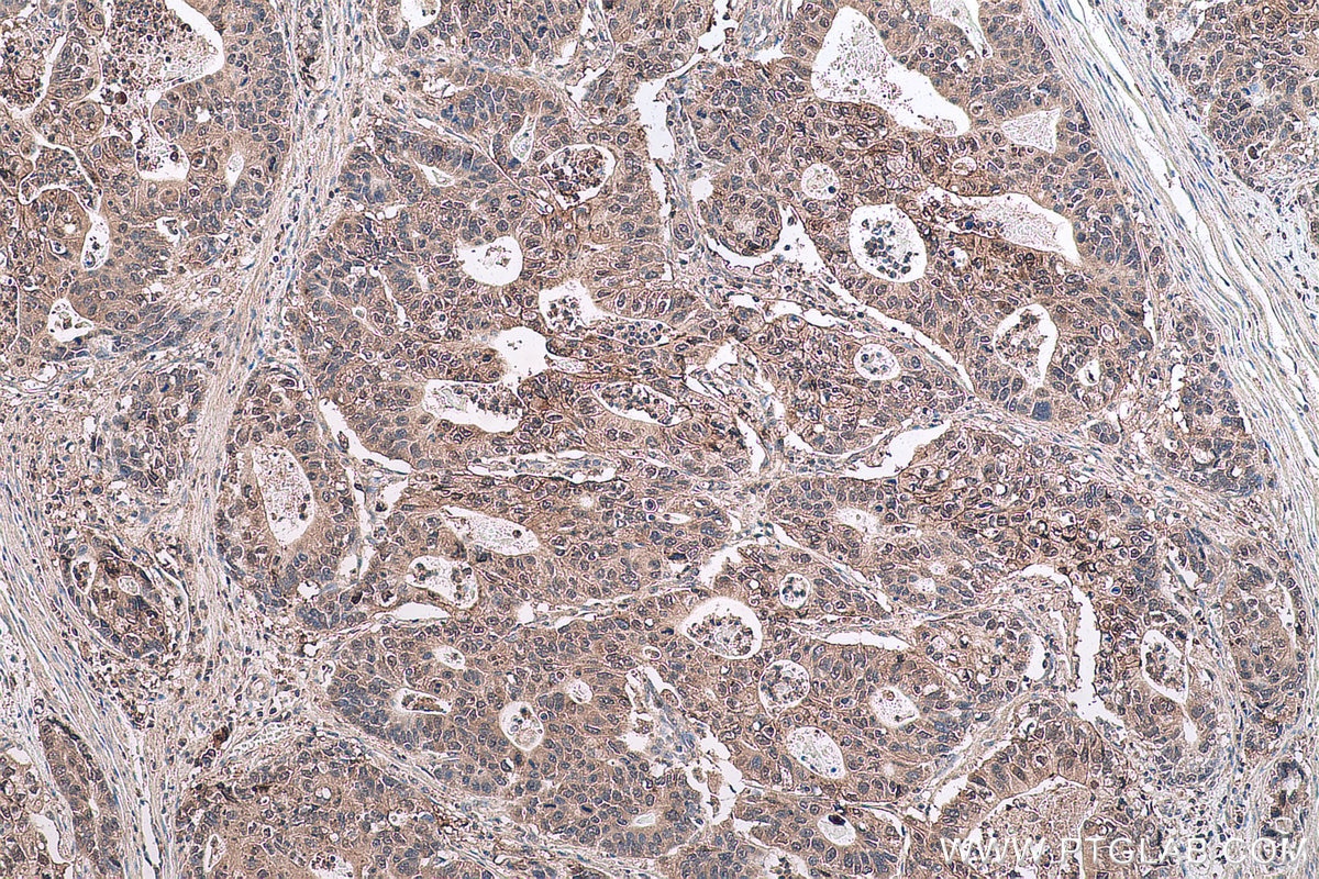 Immunohistochemical analysis of paraffin-embedded human stomach cancer tissue slide using KHC0708 (ANXA11 IHC Kit).