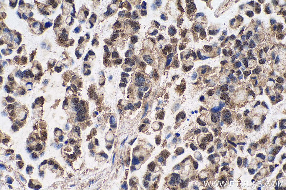 Immunohistochemical analysis of paraffin-embedded human colon cancer tissue slide using KHC0708 (ANXA11 IHC Kit).