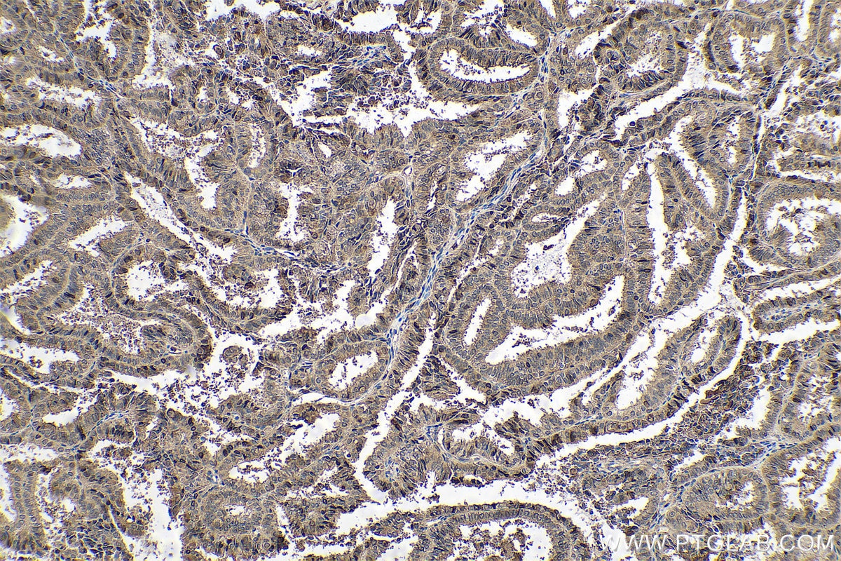 Immunohistochemical analysis of paraffin-embedded human ovary tumor tissue slide using KHC0708 (ANXA11 IHC Kit).