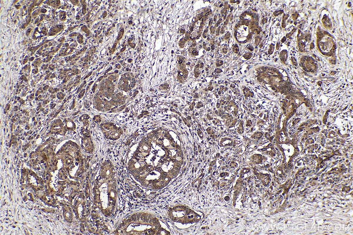 Immunohistochemical analysis of paraffin-embedded human pancreas cancer tissue slide using KHC0708 (ANXA11 IHC Kit).