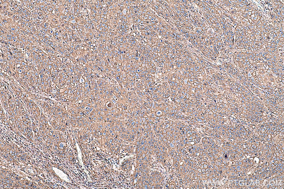 Immunohistochemical analysis of paraffin-embedded human oesophagus cancer tissue slide using KHC0396 (ANXA2 IHC Kit).