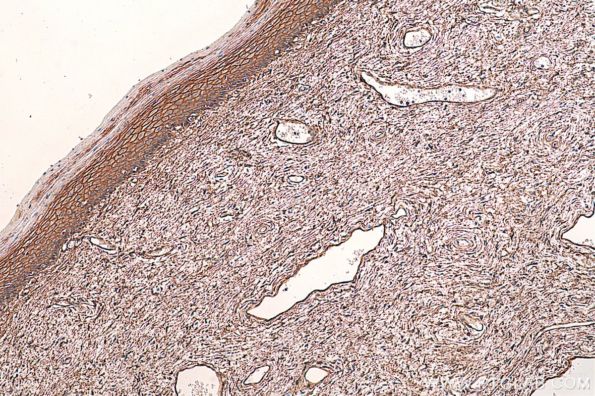 Immunohistochemical analysis of paraffin-embedded human cervical cancer tissue slide using KHC0396 (ANXA2 IHC Kit).