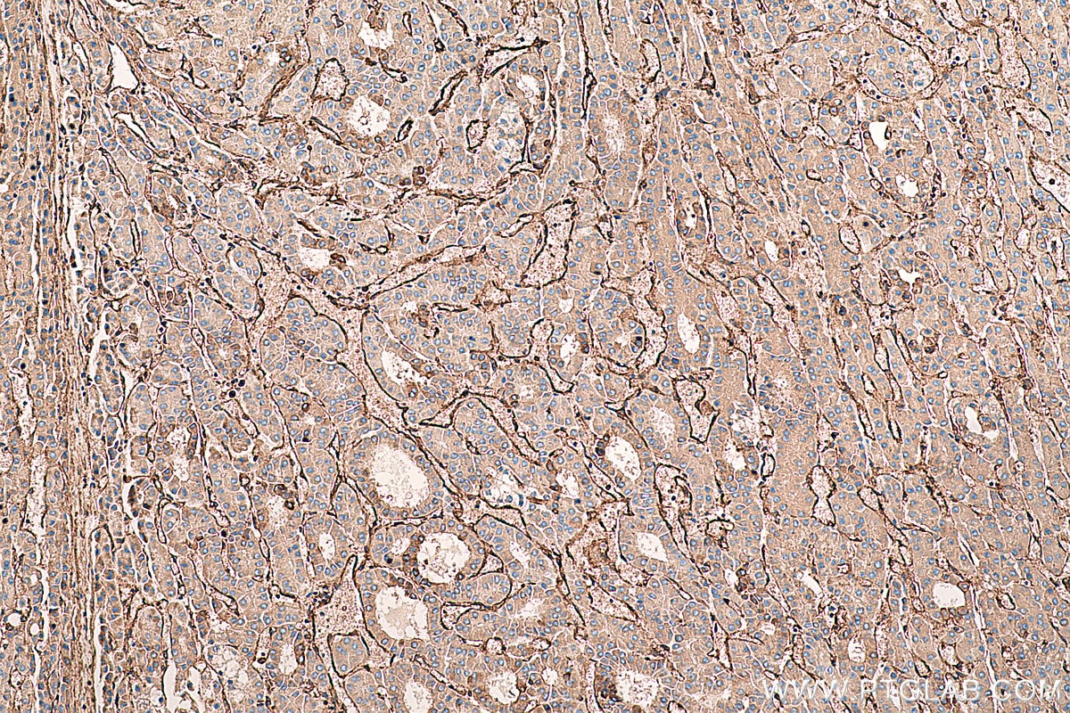 Immunohistochemical analysis of paraffin-embedded human liver cancer tissue slide using KHC0396 (ANXA2 IHC Kit).