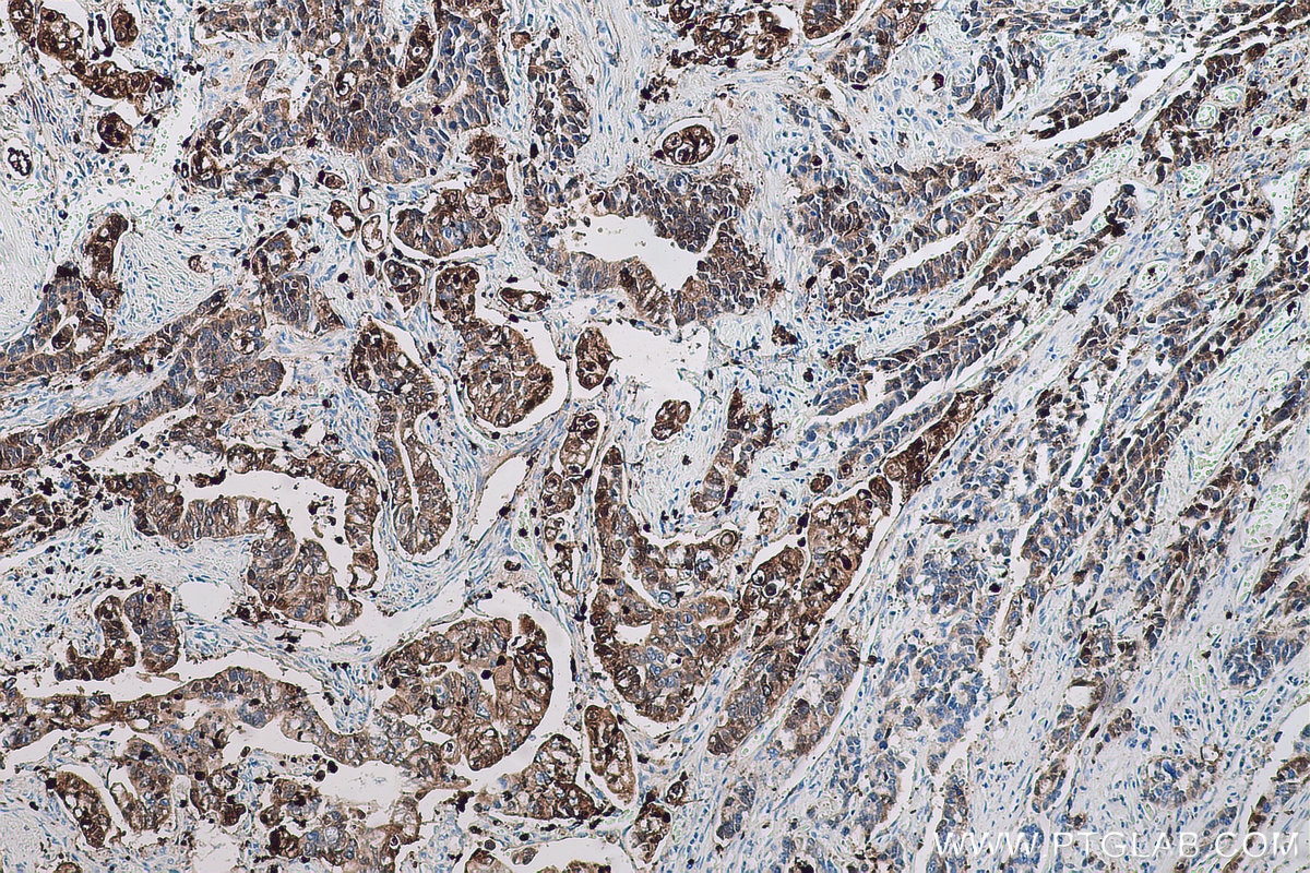 Immunohistochemical analysis of paraffin-embedded human stomach cancer tissue slide using KHC0706 (ANXA3 IHC Kit).