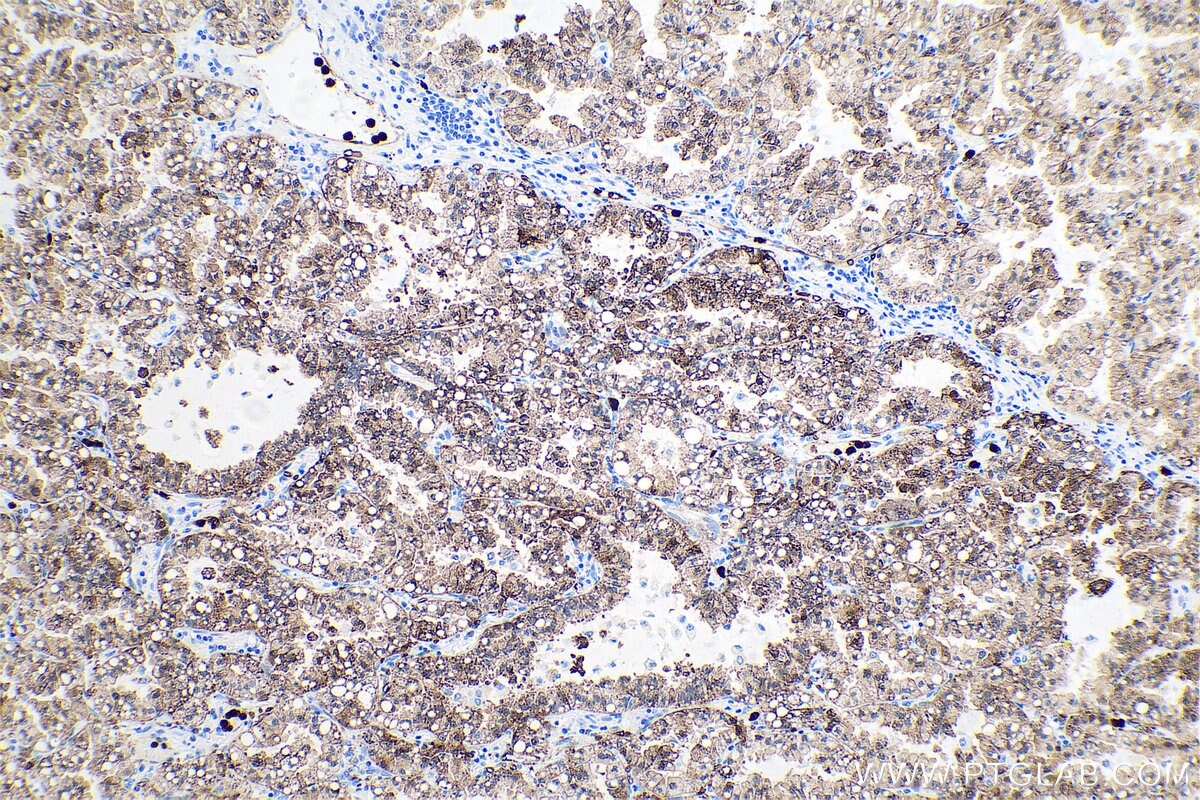 Immunohistochemical analysis of paraffin-embedded human lung cancer tissue slide using KHC0706 (ANXA3 IHC Kit).