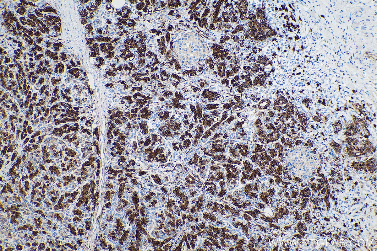 Immunohistochemical analysis of paraffin-embedded human pancreas cancer tissue slide using KHC0706 (ANXA3 IHC Kit).