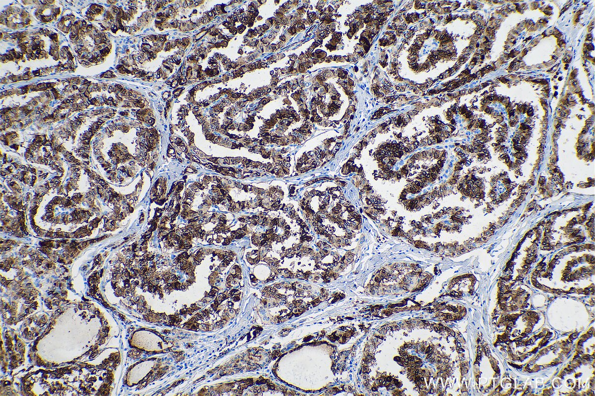 Immunohistochemical analysis of paraffin-embedded human thyroid cancer tissue slide using KHC0706 (ANXA3 IHC Kit).