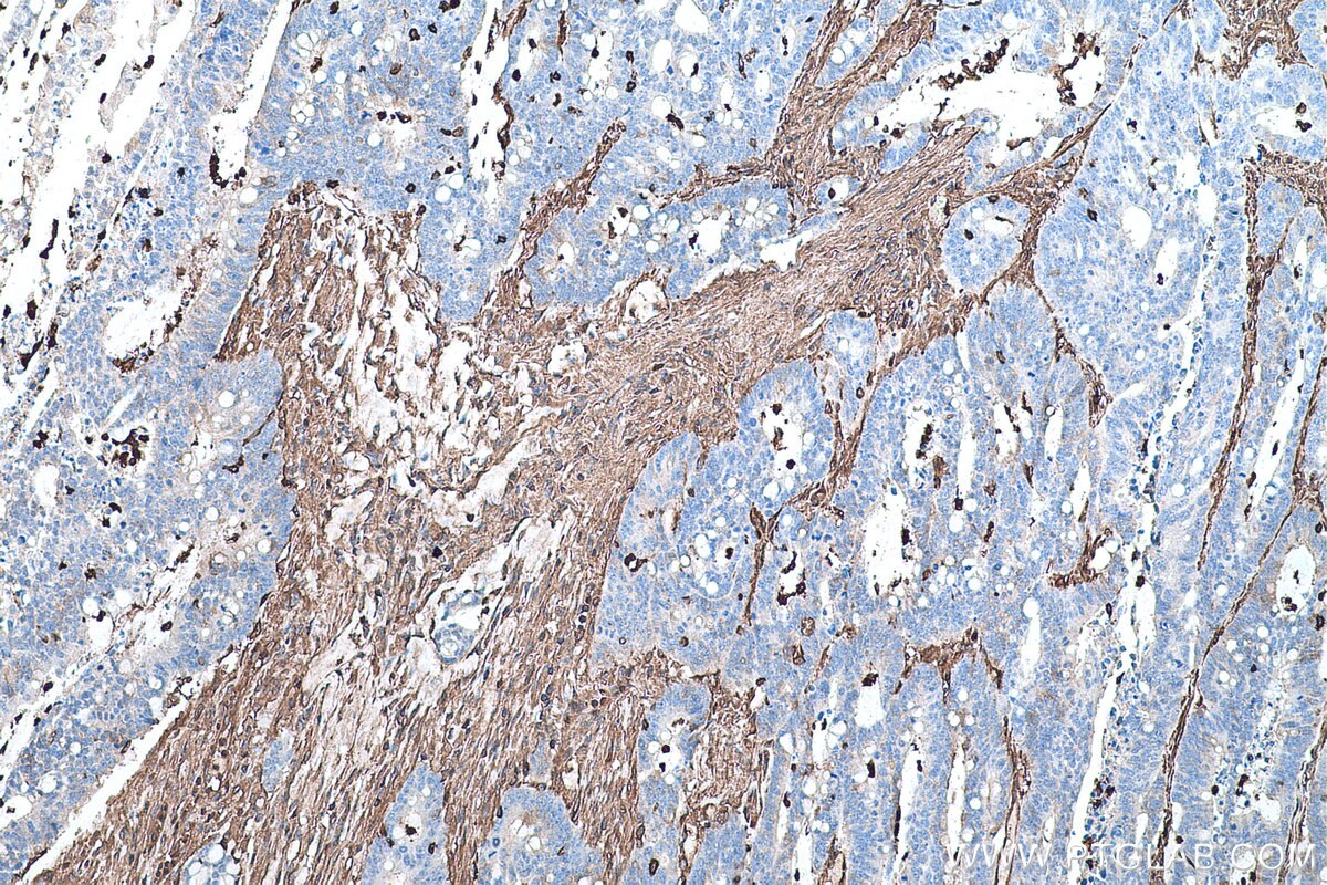 Immunohistochemical analysis of paraffin-embedded human colon cancer tissue slide using KHC0561 (ANXA6 IHC Kit).