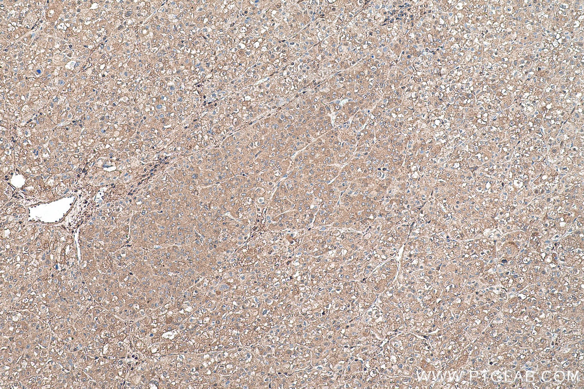 Immunohistochemical analysis of paraffin-embedded human liver cancer tissue slide using KHC0561 (ANXA6 IHC Kit).