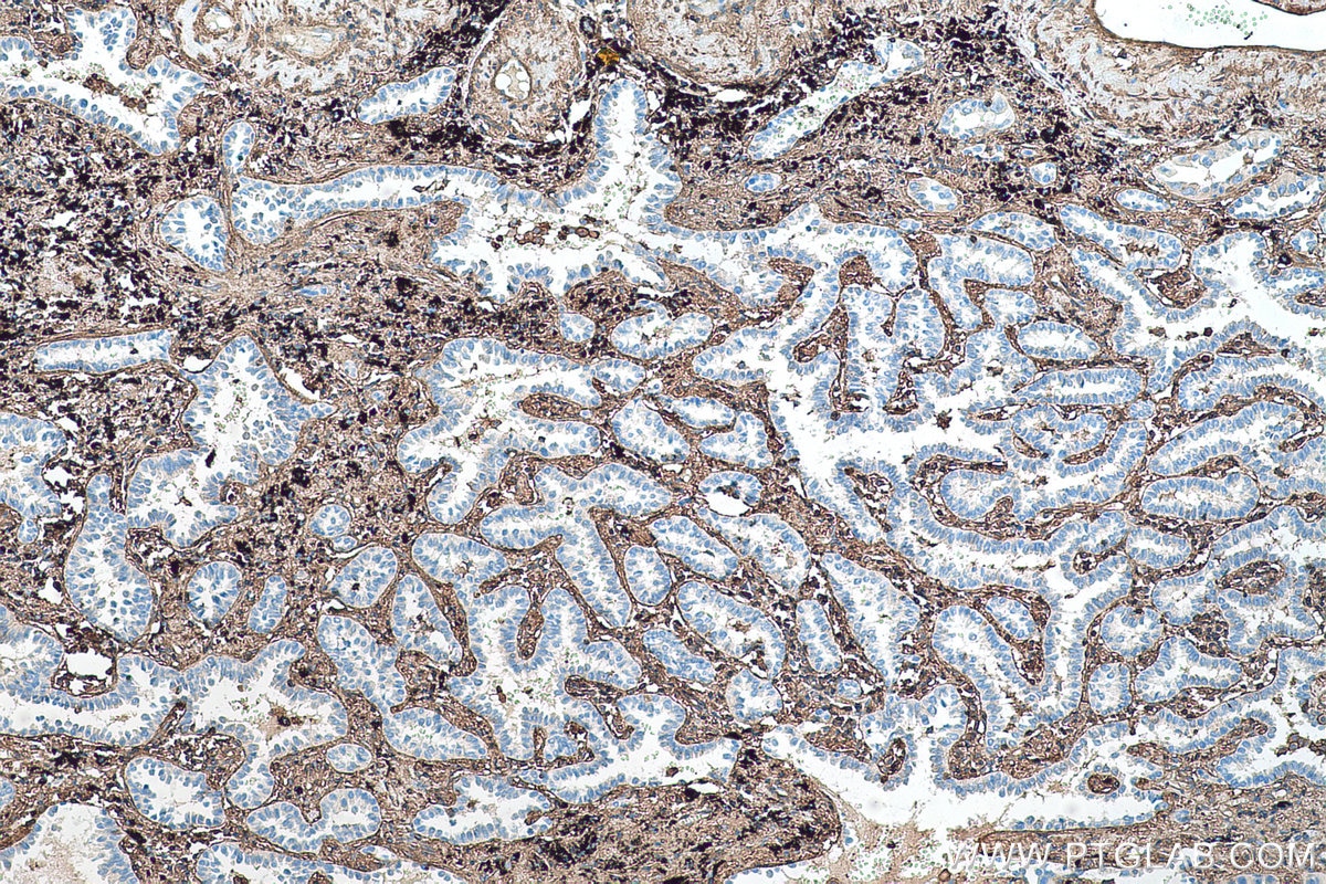 Immunohistochemical analysis of paraffin-embedded human lung cancer tissue slide using KHC0561 (ANXA6 IHC Kit).