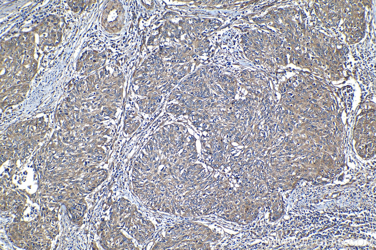 Immunohistochemical analysis of paraffin-embedded human cervical cancer tissue slide using KHC1273 (AP2A1 IHC Kit).