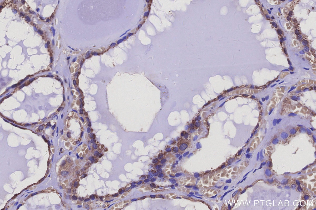 Immunohistochemical analysis of paraffin-embedded human thyroid cancer tissue slide using KHC3134 (AP3B1 IHC Kit). Immunohistochemical analysis of paraffin-embedded human thyroid cancer tissue slide using KHC3134 (AP3B1 IHC Kit).