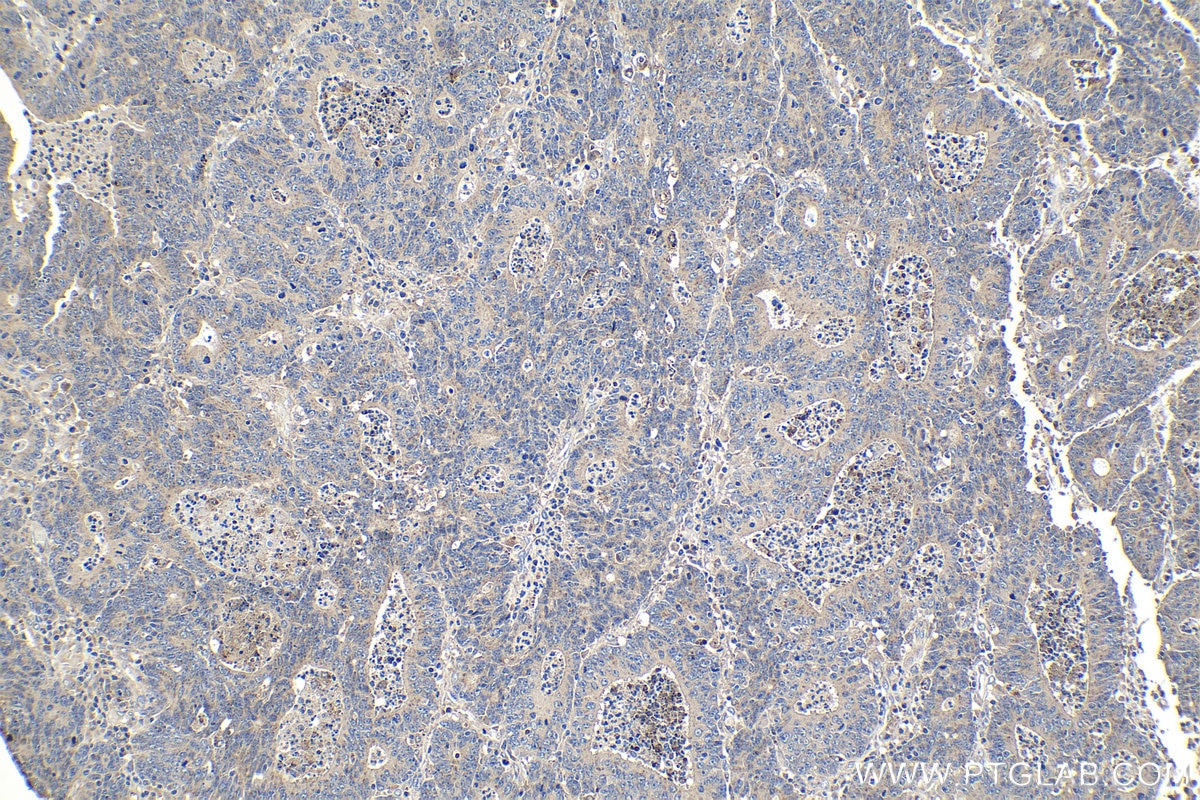 Immunohistochemical analysis of paraffin-embedded human colon cancer tissue slide using KHC1078 (APC IHC Kit).
