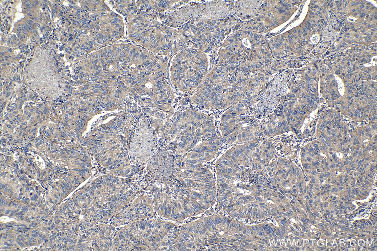 Immunohistochemical analysis of paraffin-embedded human lung cancer tissue slide using KHC1078 (APC IHC Kit).