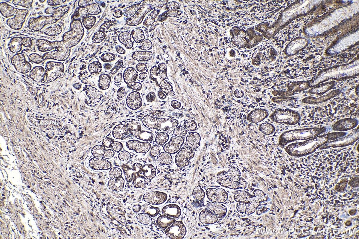 Immunohistochemical analysis of paraffin-embedded human stomach cancer tissue slide using KHC1078 (APC IHC Kit).