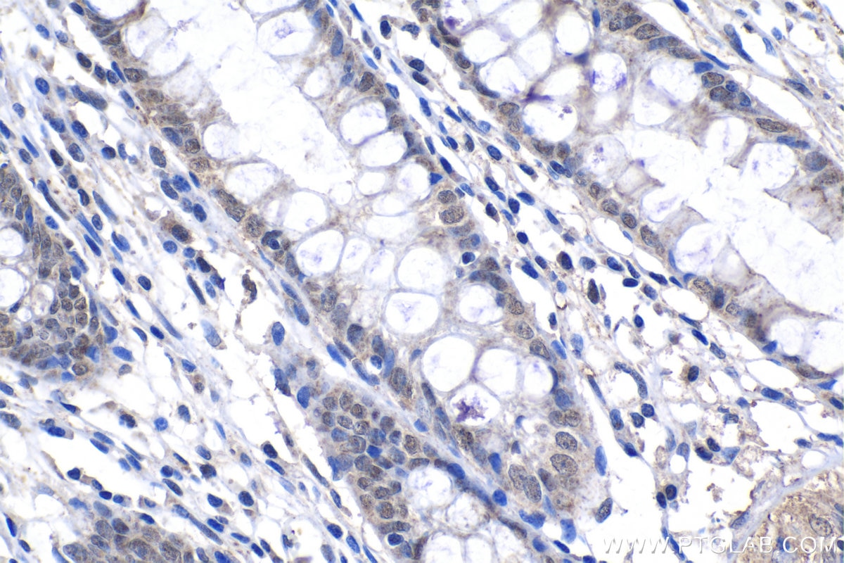 Immunohistochemical analysis of paraffin-embedded human colon tissue slide using KHC1351 (APC2 IHC Kit).