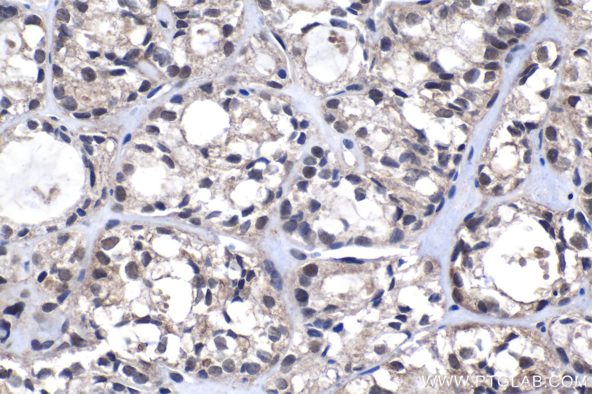 Immunohistochemical analysis of paraffin-embedded human thyroid cancer tissue slide using KHC1351 (APC2 IHC Kit).