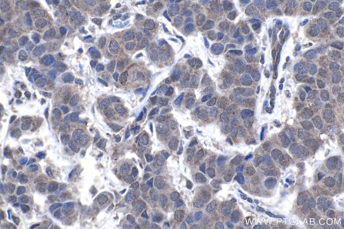 Immunohistochemical analysis of paraffin-embedded human breast cancer tissue slide using KHC1351 (APC2 IHC Kit).