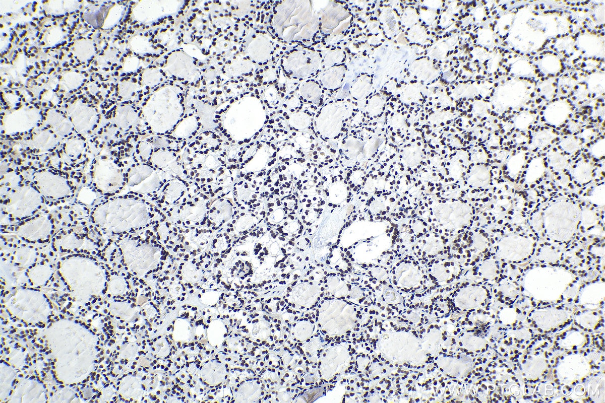 Immunohistochemical analysis of paraffin-embedded human thyroid cancer tissue slide using KHC1569 (APEX1 IHC Kit).