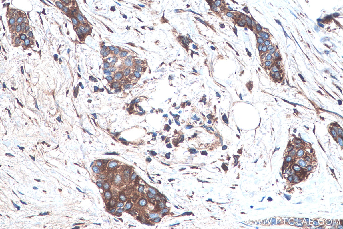 Immunohistochemical analysis of paraffin-embedded human urothelial carcinoma tissue slide using KHC0491 (APOA1 IHC Kit).