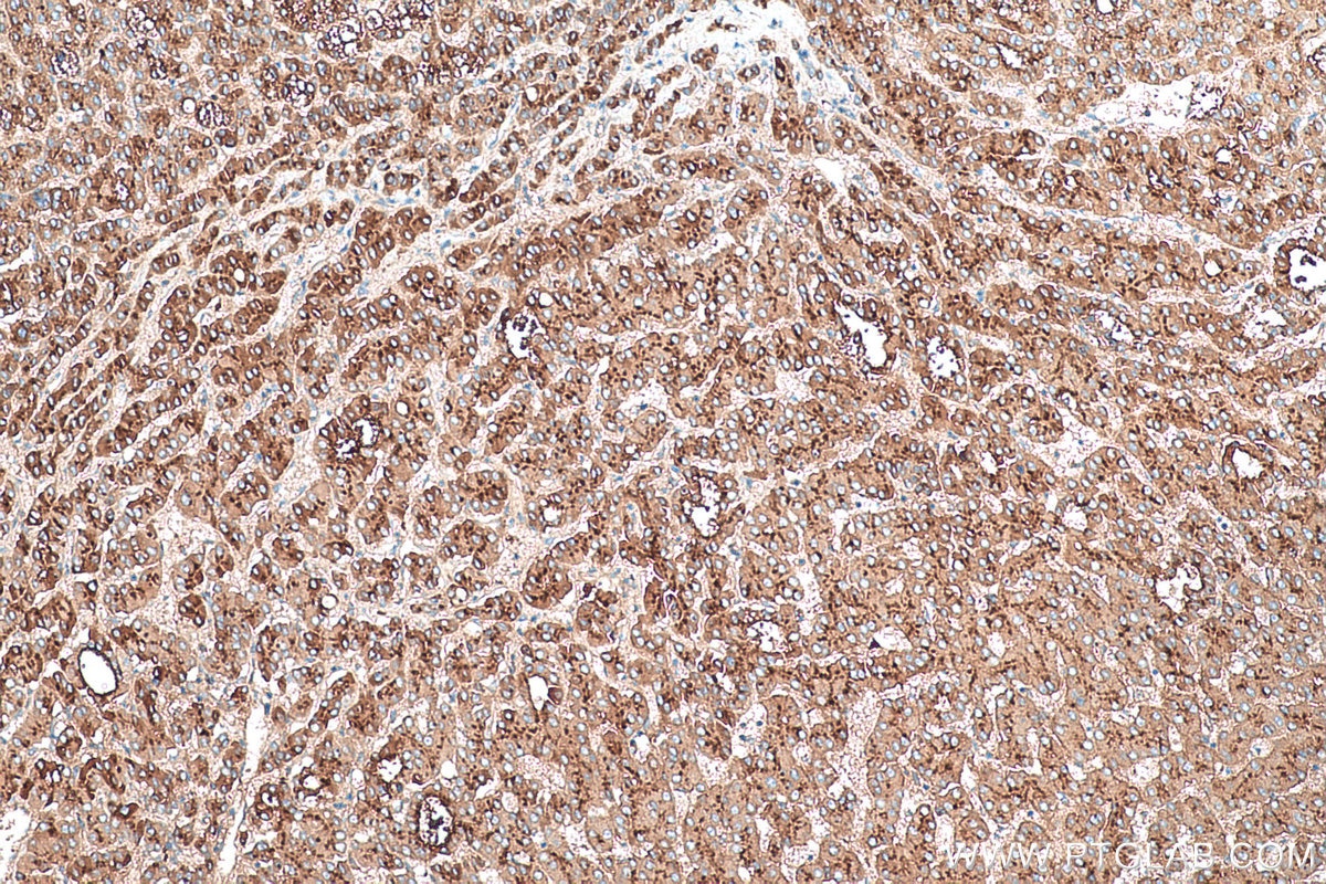 Immunohistochemical analysis of paraffin-embedded human liver cancer tissue slide using KHC0381 (APOA2 IHC Kit).