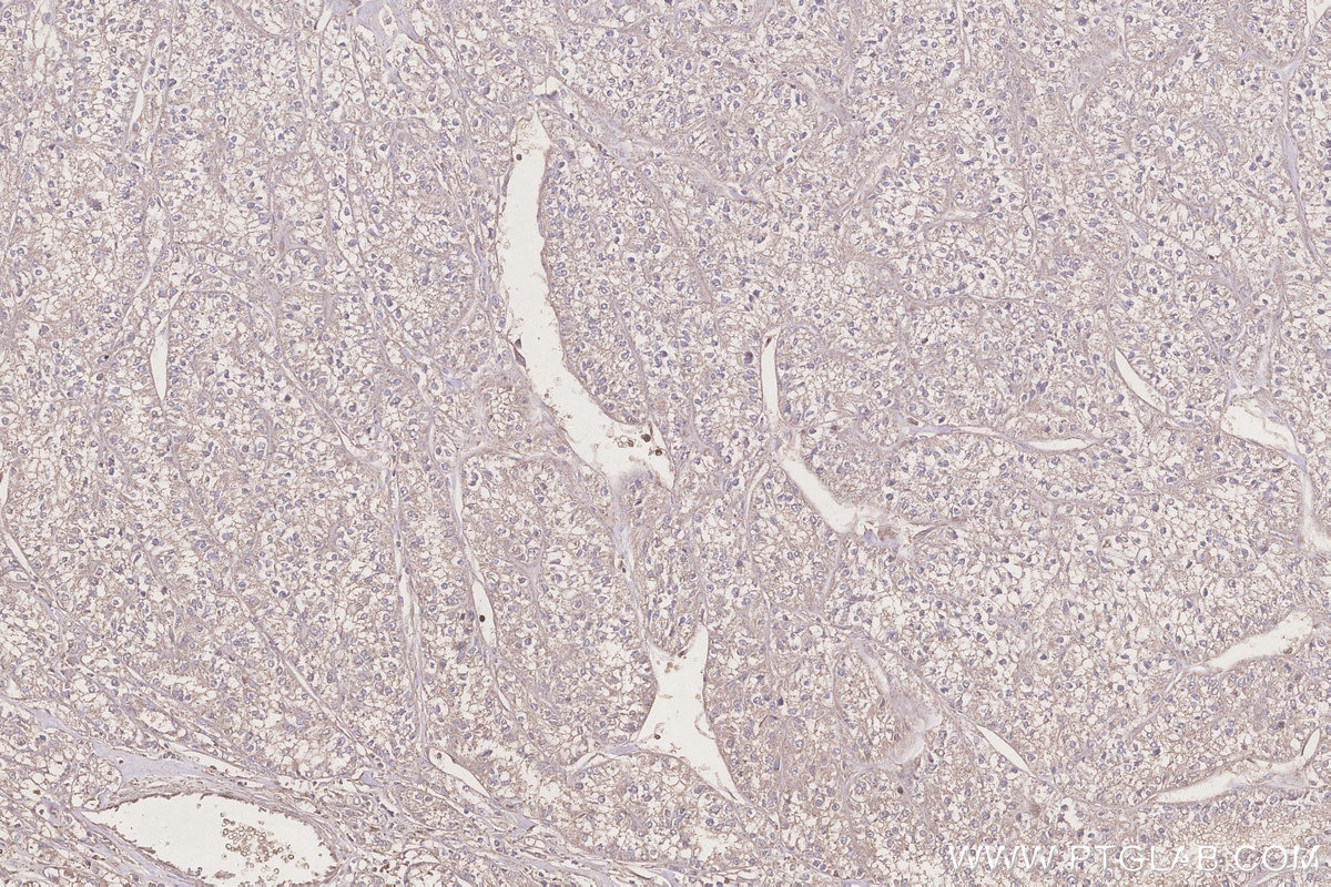 Immunohistochemical analysis of paraffin-embedded human renal cell carcinoma tissue slide using KHC3245 (APOA4 IHC Kit).