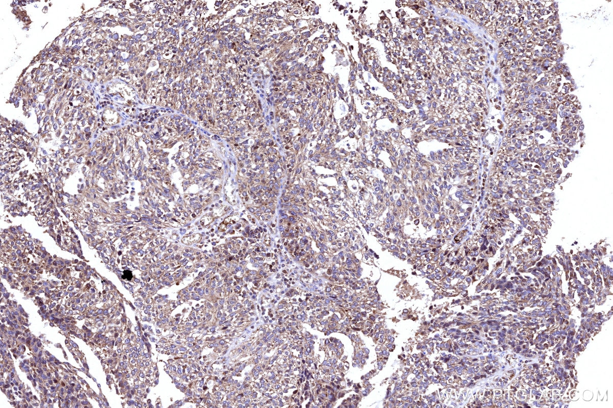 Immunohistochemical analysis of paraffin-embedded human ovary cancer tissue slide using KHC3167 (APOB IHC Kit).