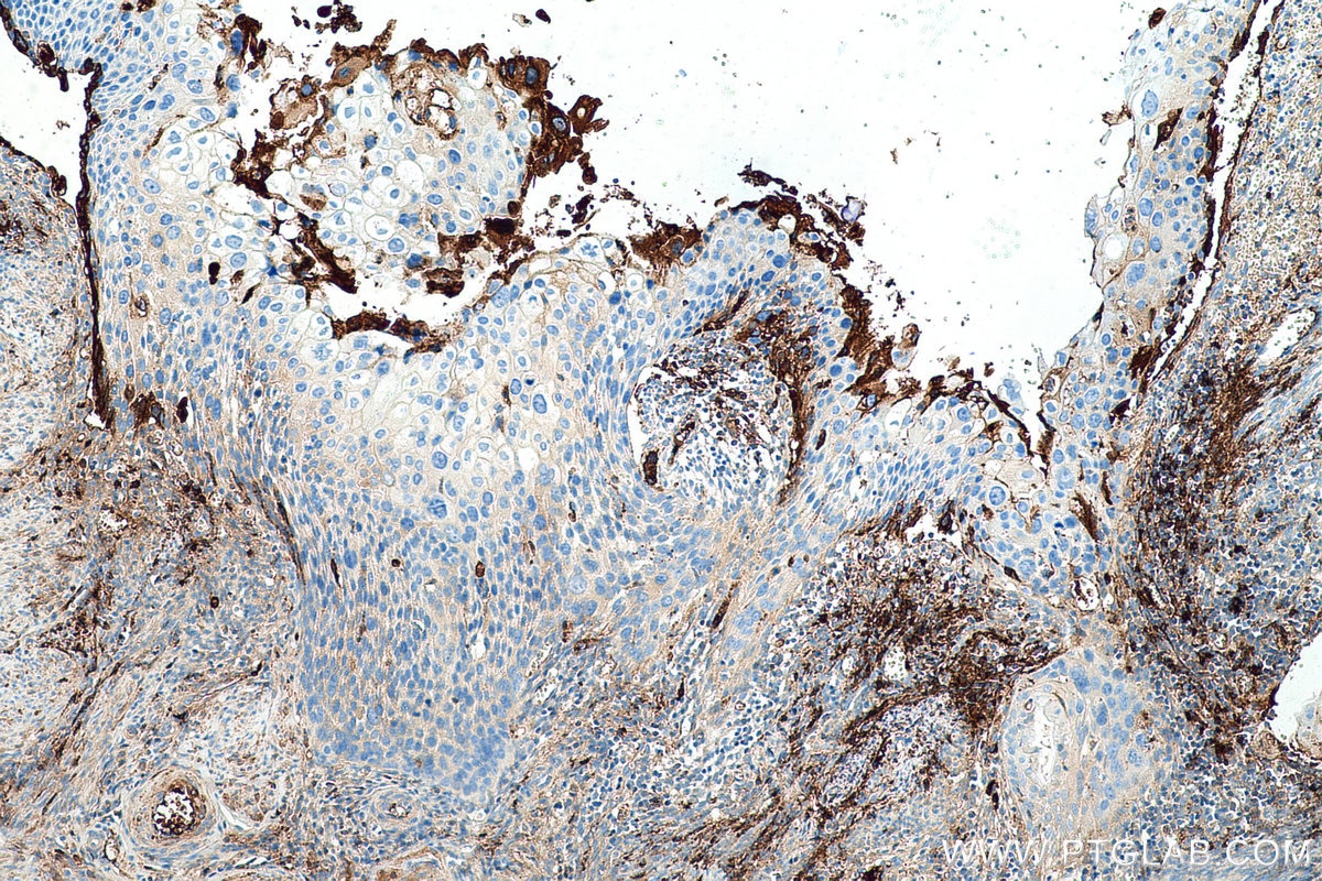 Immunohistochemical analysis of paraffin-embedded human cervical cancer tissue slide using KHC0492 (APOC1 IHC Kit).