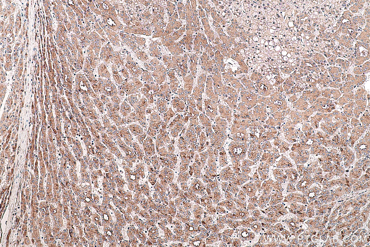 Immunohistochemical analysis of paraffin-embedded human liver cancer tissue slide using KHC0382 (APOH IHC Kit).