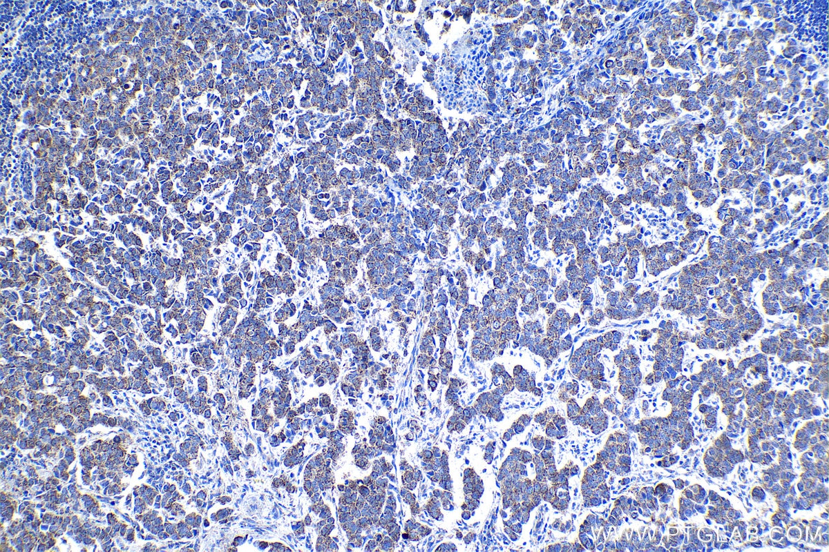 Immunohistochemical analysis of paraffin-embedded human breast cancer tissue slide using KHC1352 (APOOL IHC Kit).