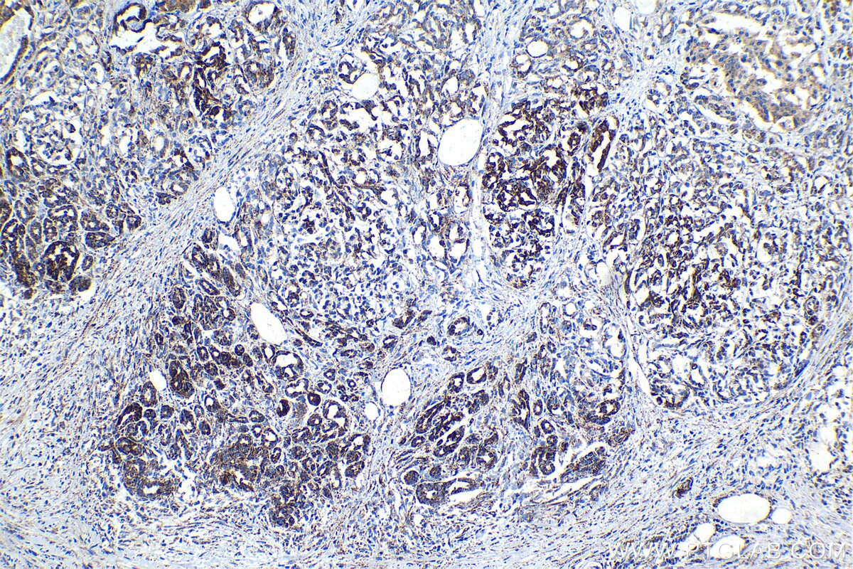 Immunohistochemical analysis of paraffin-embedded human pancreas cancer tissue slide using KHC1352 (APOOL IHC Kit).