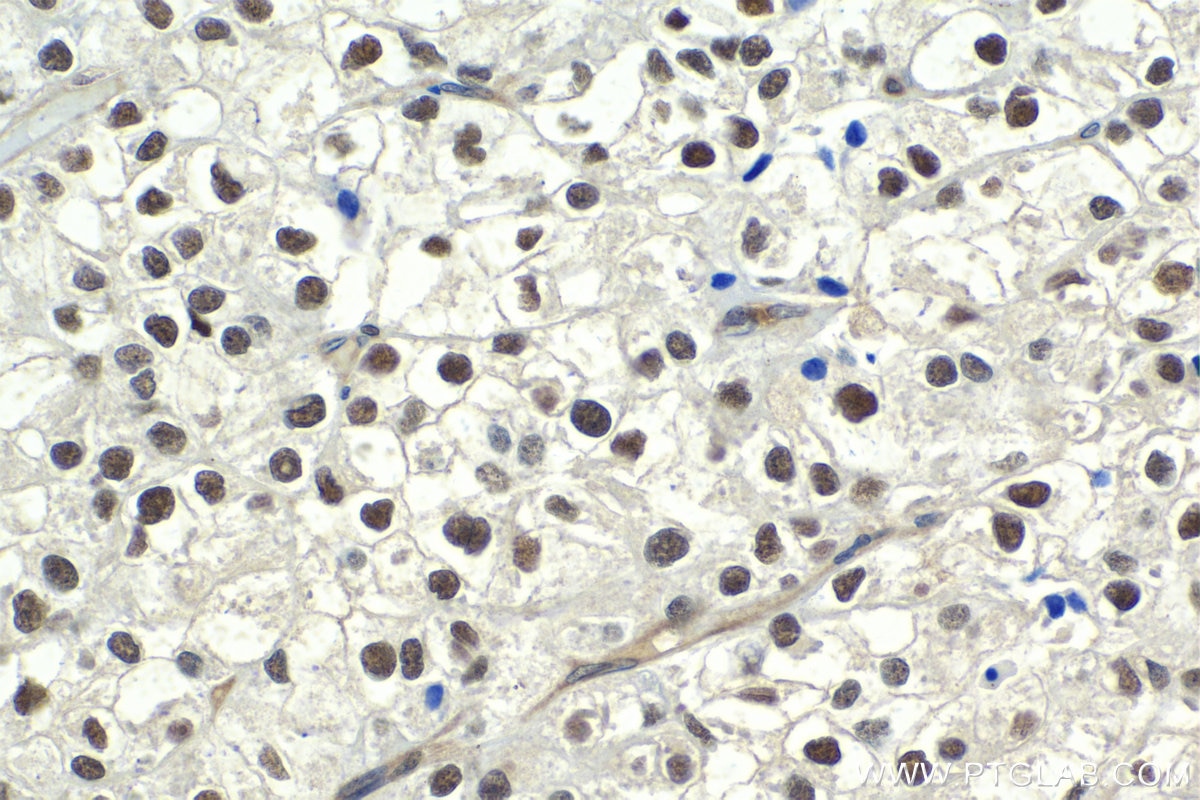 Immunohistochemical analysis of paraffin-embedded human endometrial cancer tissue slide using KHC1992 (APPL1 IHC Kit).