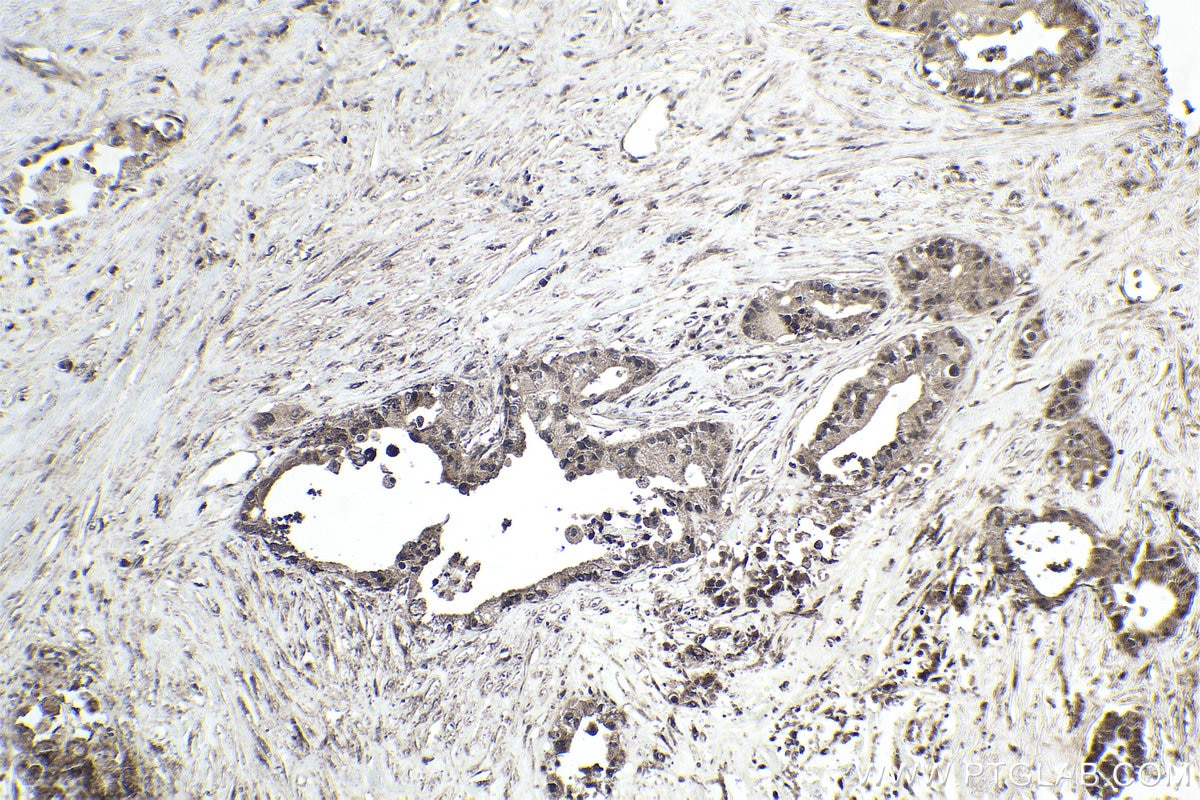 Immunohistochemical analysis of paraffin-embedded human pancreas cancer tissue slide using KHC1837 (APPL2 IHC Kit).