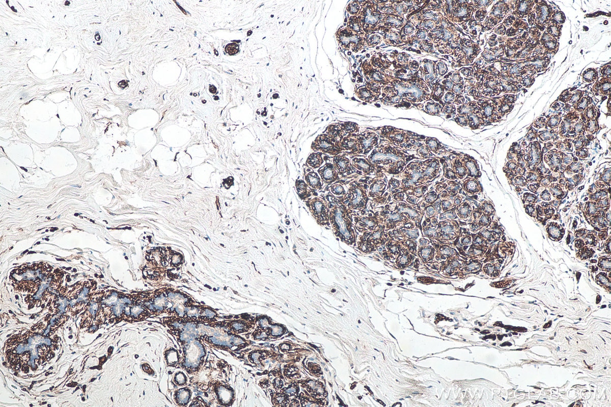 Immunohistochemical analysis of paraffin-embedded human breast cancer tissue slide using KHC0083 (AQP1 IHC Kit).