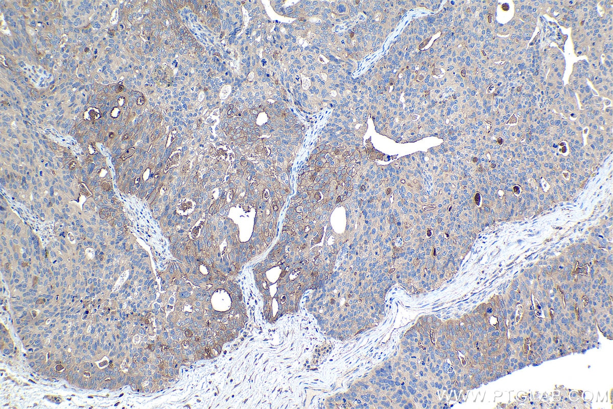 Immunohistochemical analysis of paraffin-embedded human ovary tumor tissue slide using KHC1094 (AQP5 IHC Kit).