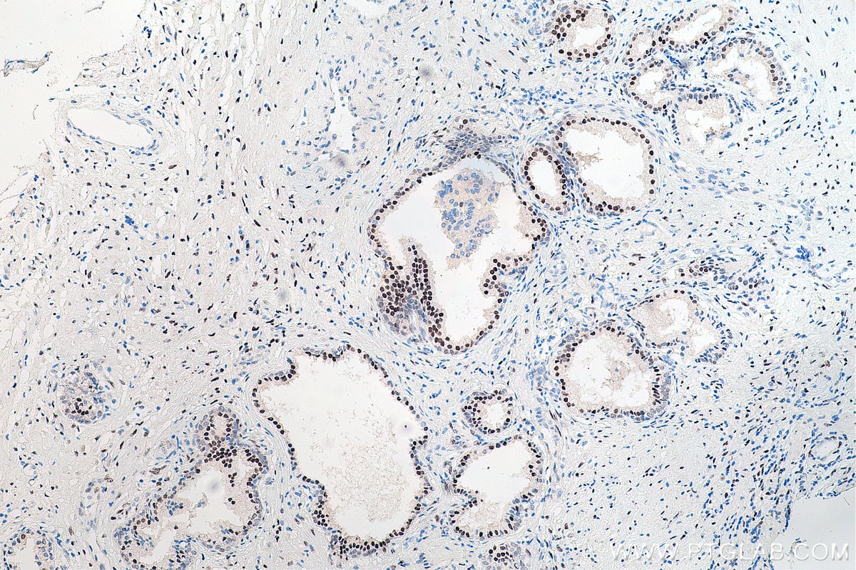 Immunohistochemical analysis of paraffin-embedded human prostate cancer tissue slide using KHC0097 (AR IHC Kit).