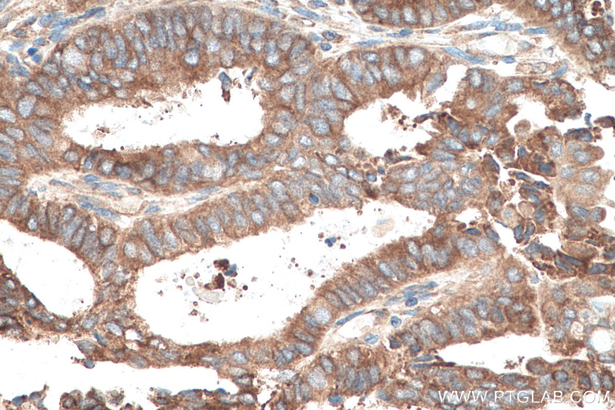 Immunohistochemical analysis of paraffin-embedded human ovary tumor tissue slide using KHC0808 (Amphiregulin IHC Kit).
