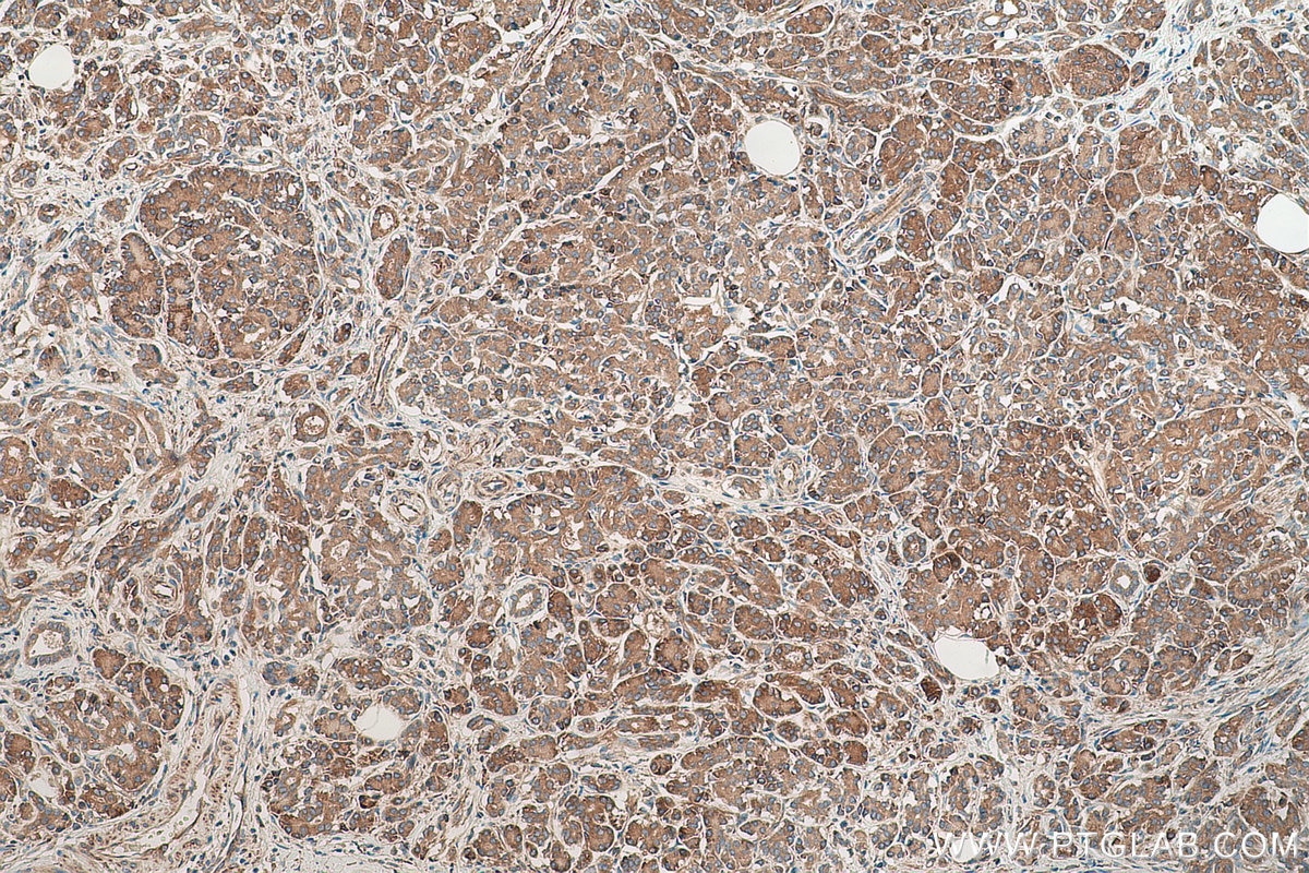 Immunohistochemical analysis of paraffin-embedded human pancreas cancer tissue slide using KHC0808 (Amphiregulin IHC Kit).