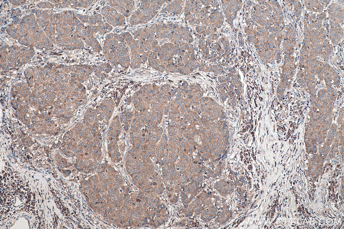 Immunohistochemical analysis of paraffin-embedded human stomach cancer tissue slide using KHC0808 (Amphiregulin IHC Kit).