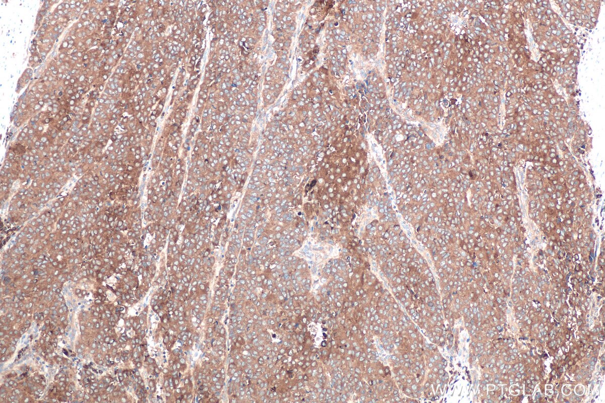 Immunohistochemical analysis of paraffin-embedded human stomach cancer tissue slide using KHC0712 (ARF1 IHC Kit).