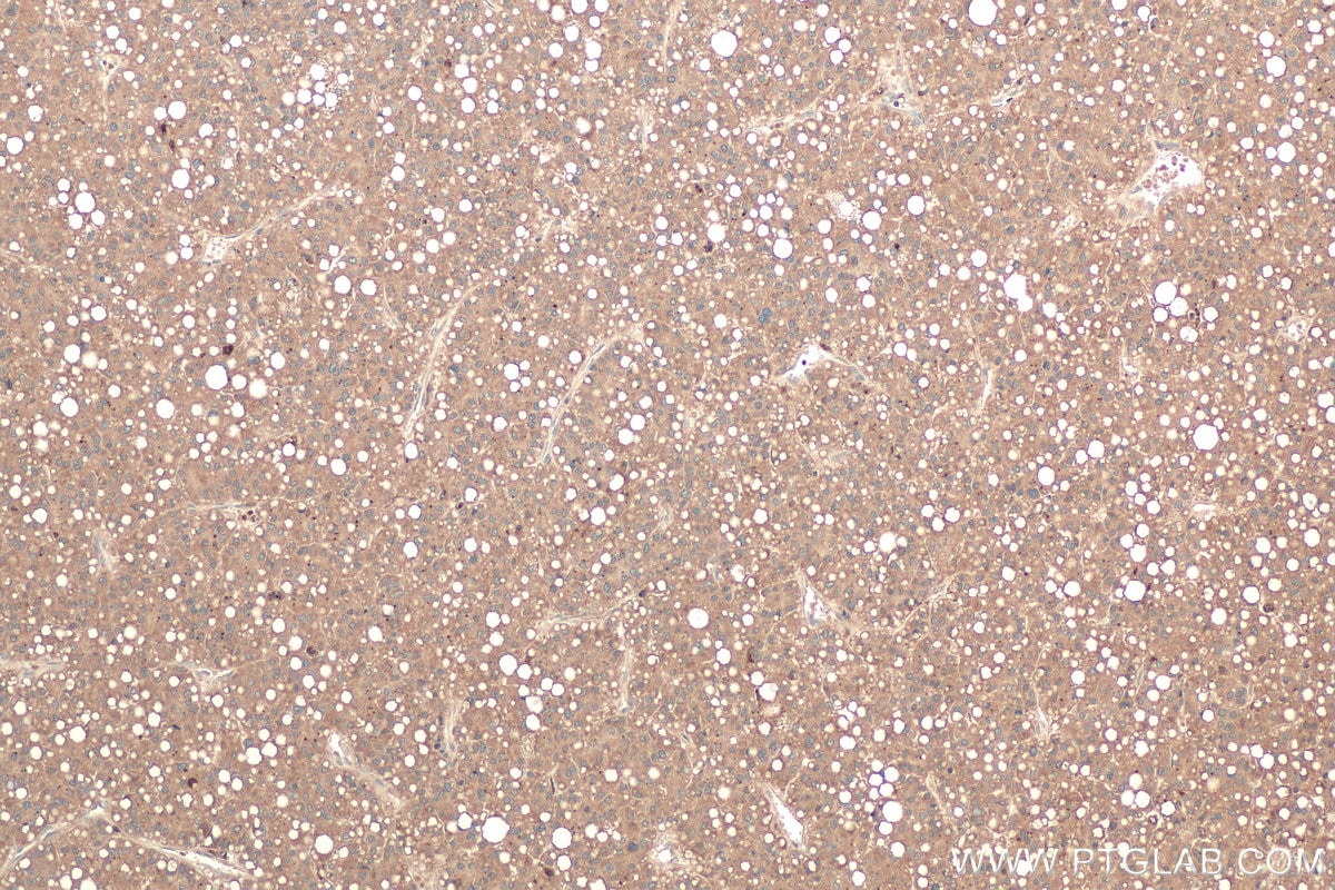 Immunohistochemical analysis of paraffin-embedded human liver cancer tissue slide using KHC0713 (ARF3 IHC Kit).
