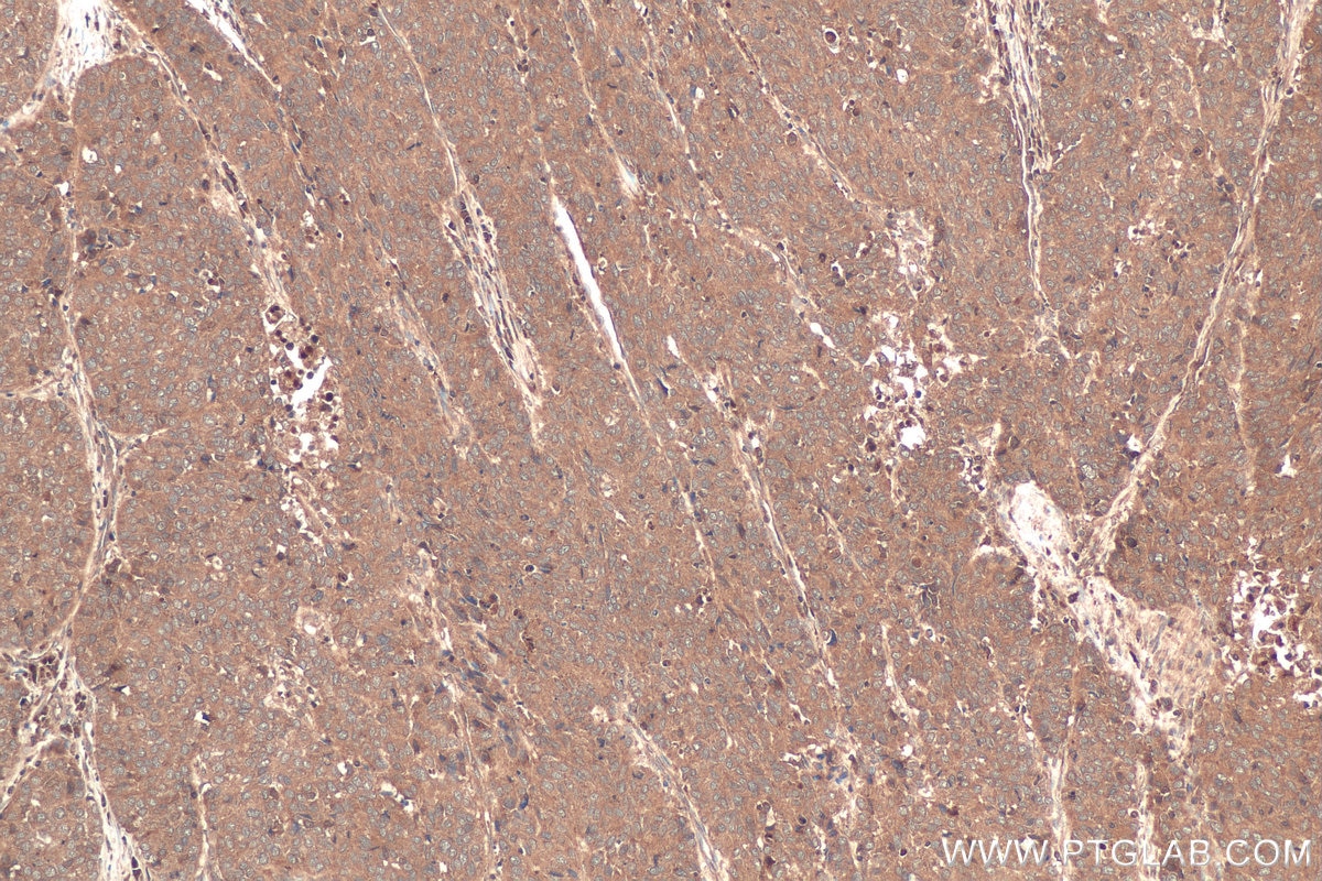 Immunohistochemical analysis of paraffin-embedded human stomach cancer tissue slide using KHC0713 (ARF3 IHC Kit).