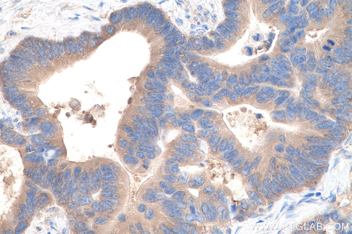 Immunohistochemical analysis of paraffin-embedded human colon cancer tissue slide using KHC0865 (ARFIP1 IHC Kit).