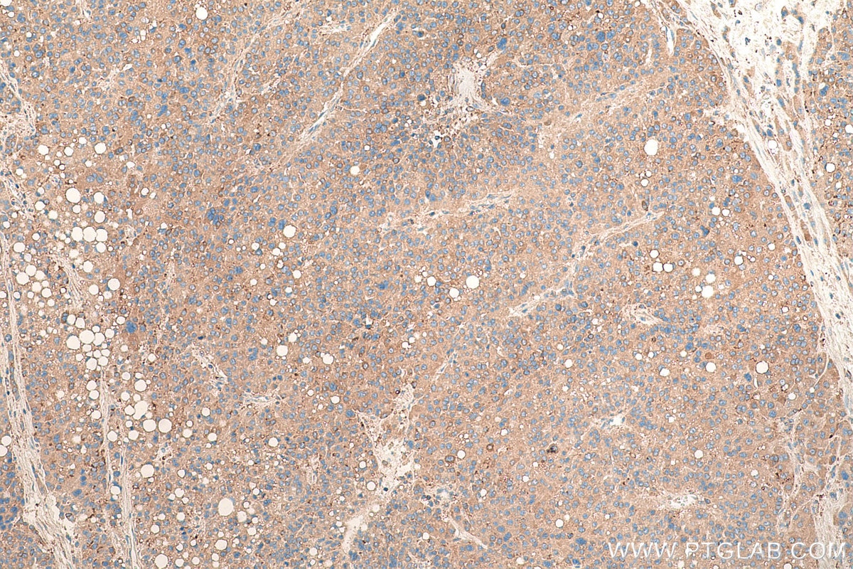 Immunohistochemical analysis of paraffin-embedded human liver cancer tissue slide using KHC0865 (ARFIP1 IHC Kit).