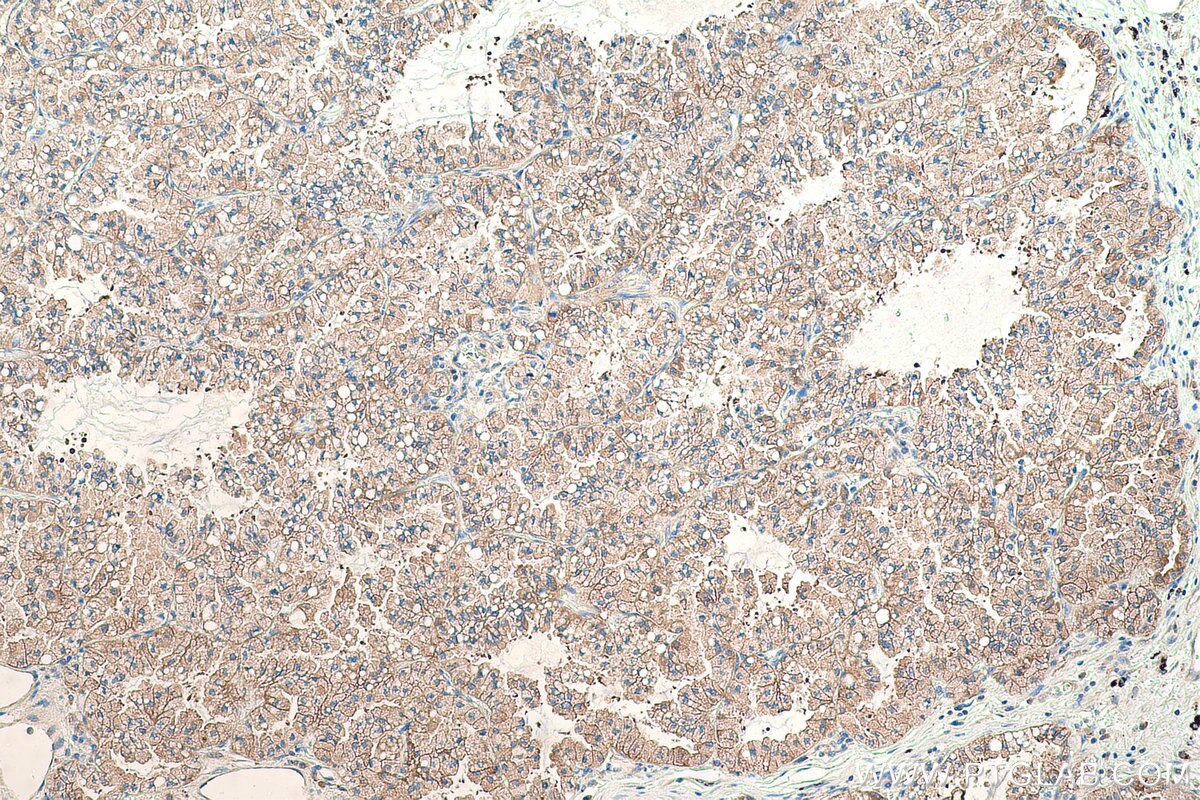 Immunohistochemical analysis of paraffin-embedded human lung cancer tissue slide using KHC0865 (ARFIP1 IHC Kit).