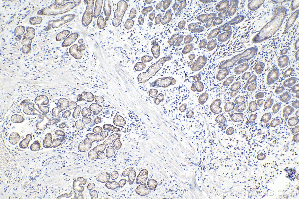 Immunohistochemical analysis of paraffin-embedded human stomach cancer tissue slide using KHC0980 (ARFIP2 IHC Kit).