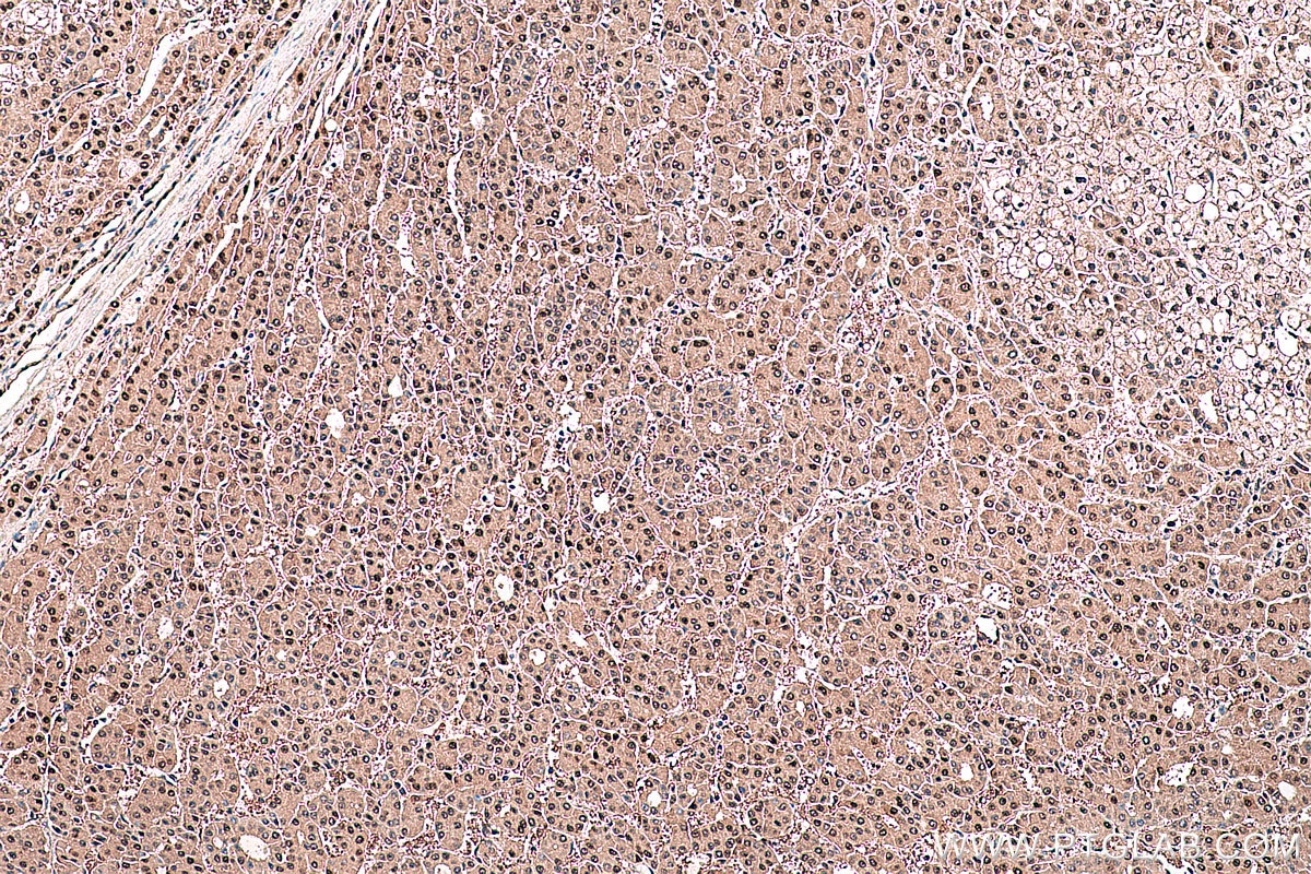 Immunohistochemical analysis of paraffin-embedded human liver cancer tissue slide using KHC0383 (ARG1 IHC Kit).