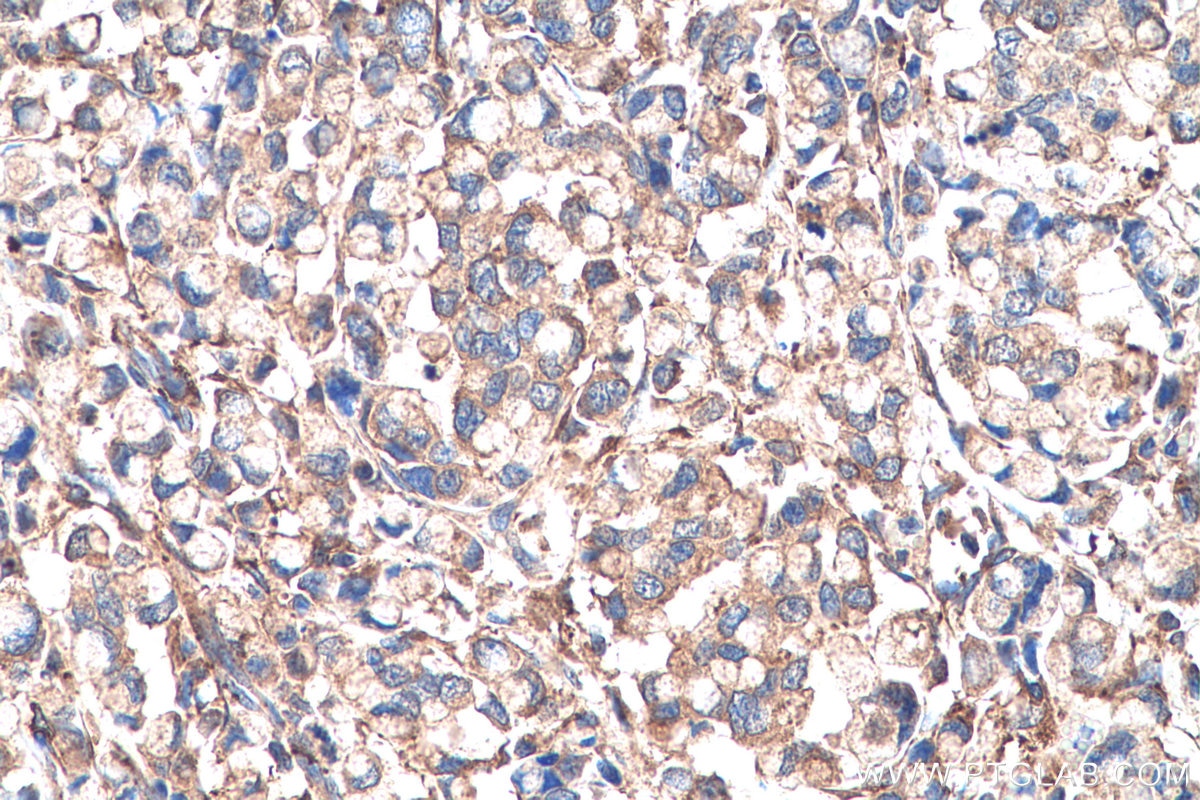 Immunohistochemical analysis of paraffin-embedded human colon cancer tissue slide using KHC0717 (ARHGAP1 IHC Kit).